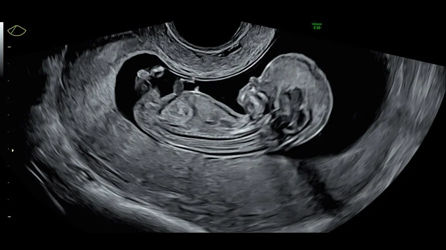 Ultrassom 2D fetal.